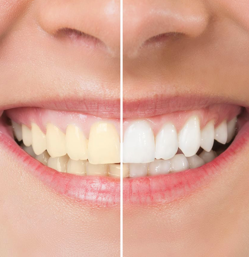 Before and after teeth whitening comparison showing yellowed teeth transforming to bright white smile.